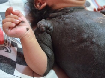 Bebê com doença rara, nasceu com aproximadamente 80% do corpo encoberto por manchas e bolhas escuras