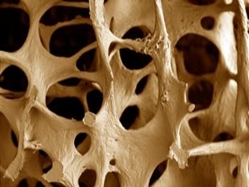Uma em cada três mulheres acima de 50 anos terá osteoporose, diz IOF